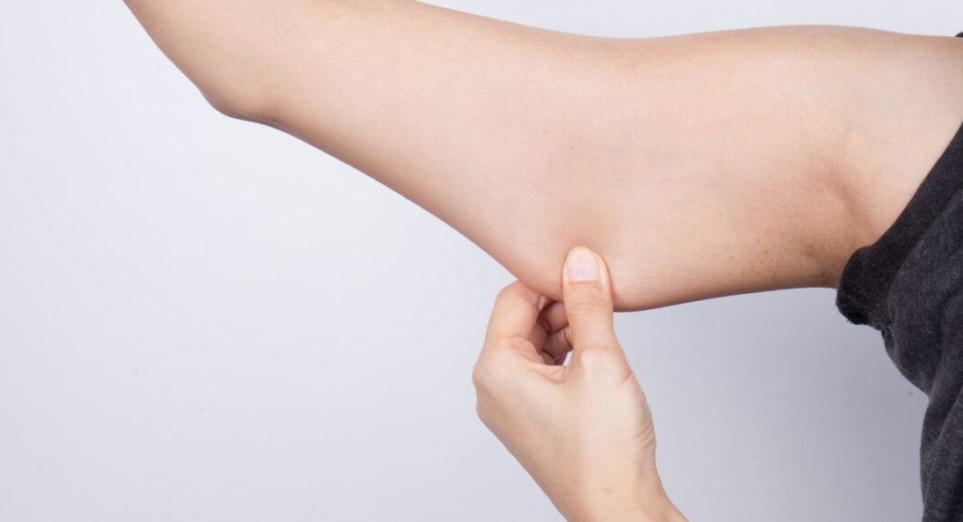 Le lipodème se caractérise pas des dépôts douloureux de graisse dans les bras et les jambes.